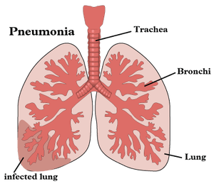 Gejala Penyakit Pneumonia, Penyebab dan Pencegahannya
