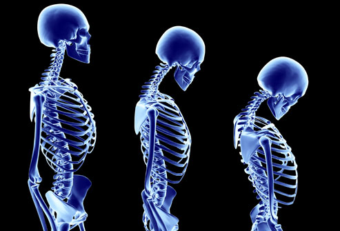 Enam Cara Hadang Osteoporosis